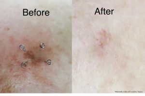 photo of before and after acupuncture for skin care treatment