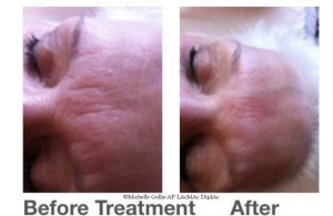 photo of before and after acupuncture treatment for skin care