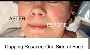 photo of before and after treatment for rosacea